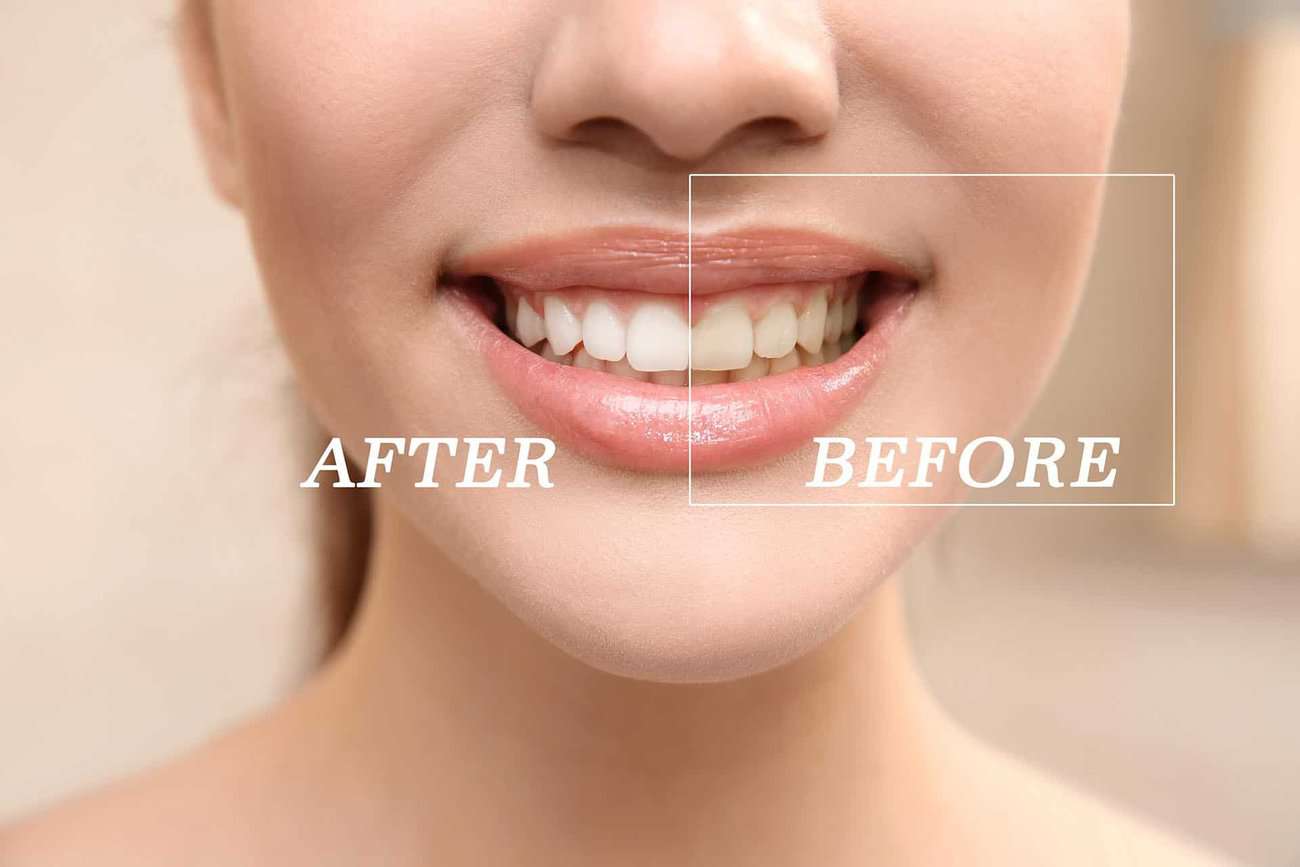 How Can You Maintain a Consistent Smile Shade with Crowns Rugby?