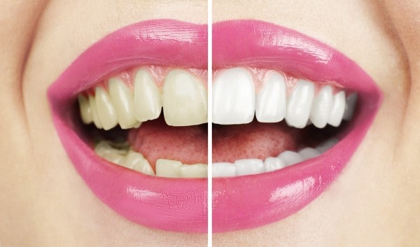 What Makes Ultima White Teeth Whitening Different Rugby