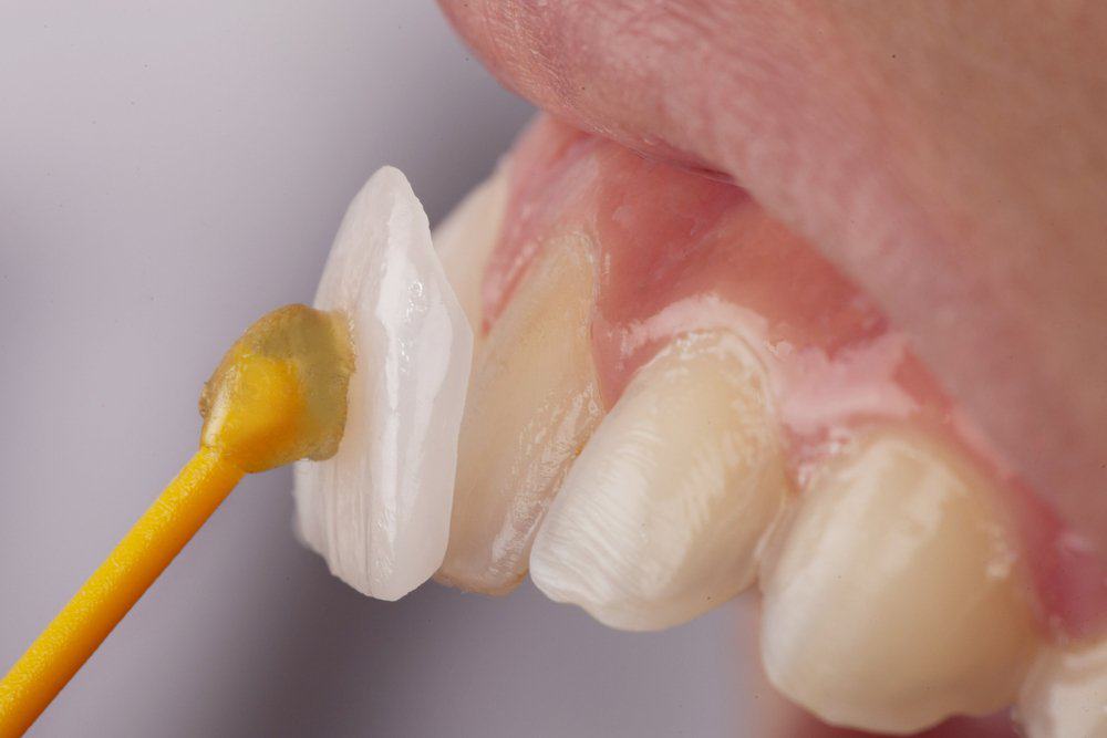 Why Do Dental Crowns Fail or Get Damaged Prematurely Rugby?