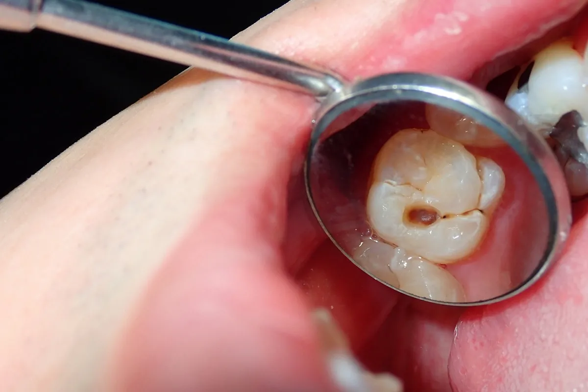 Why Do Teeth Crack? Common Causes to Know Rugby