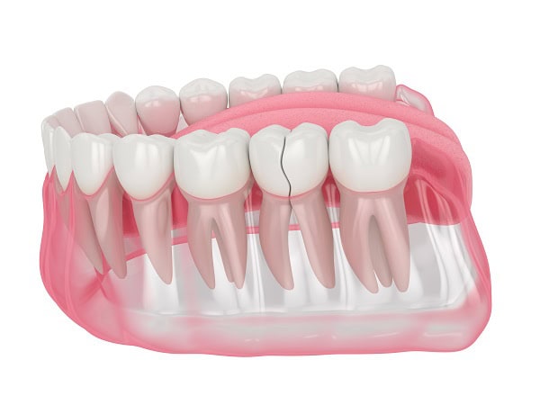 How Can You Manage Pain and Discomfort After a Root Canal Rugby?