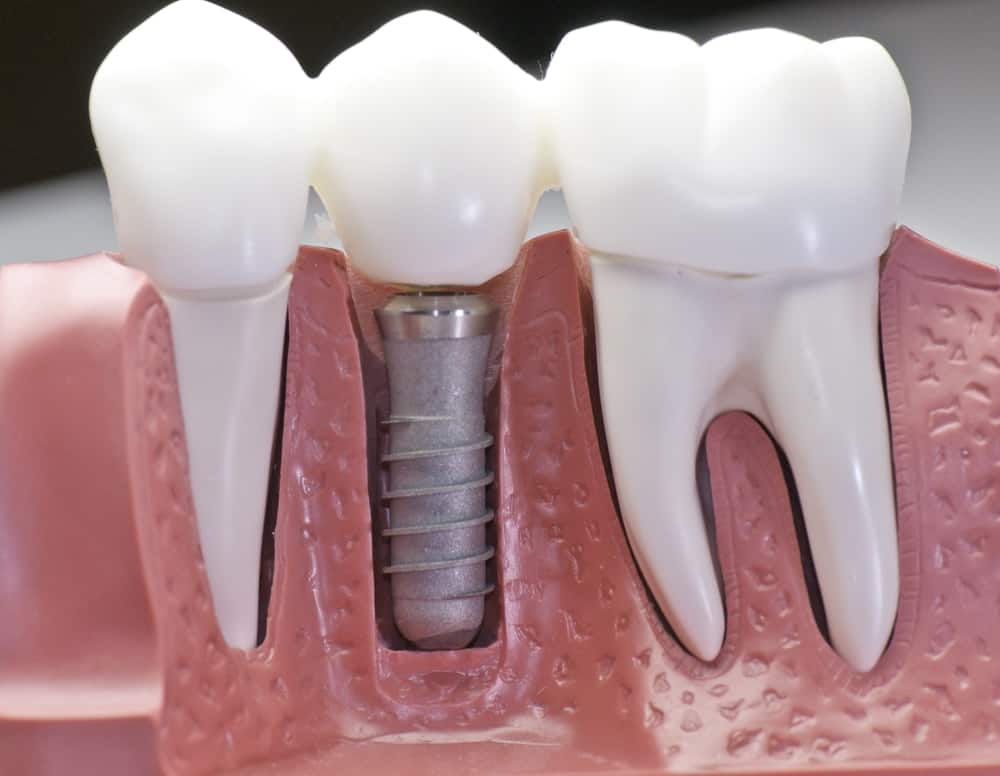 Who Is a Good Candidate for Dental Implants Rugby?
