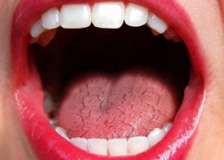 Dry Mouth and Its Role in Tooth Decay Rugby