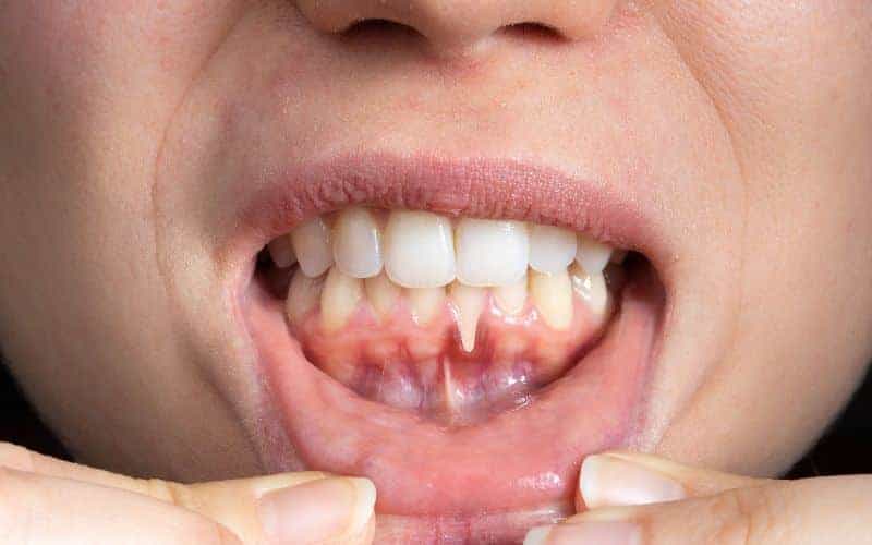 How Can Gum Disease Be Prevented Rugby?