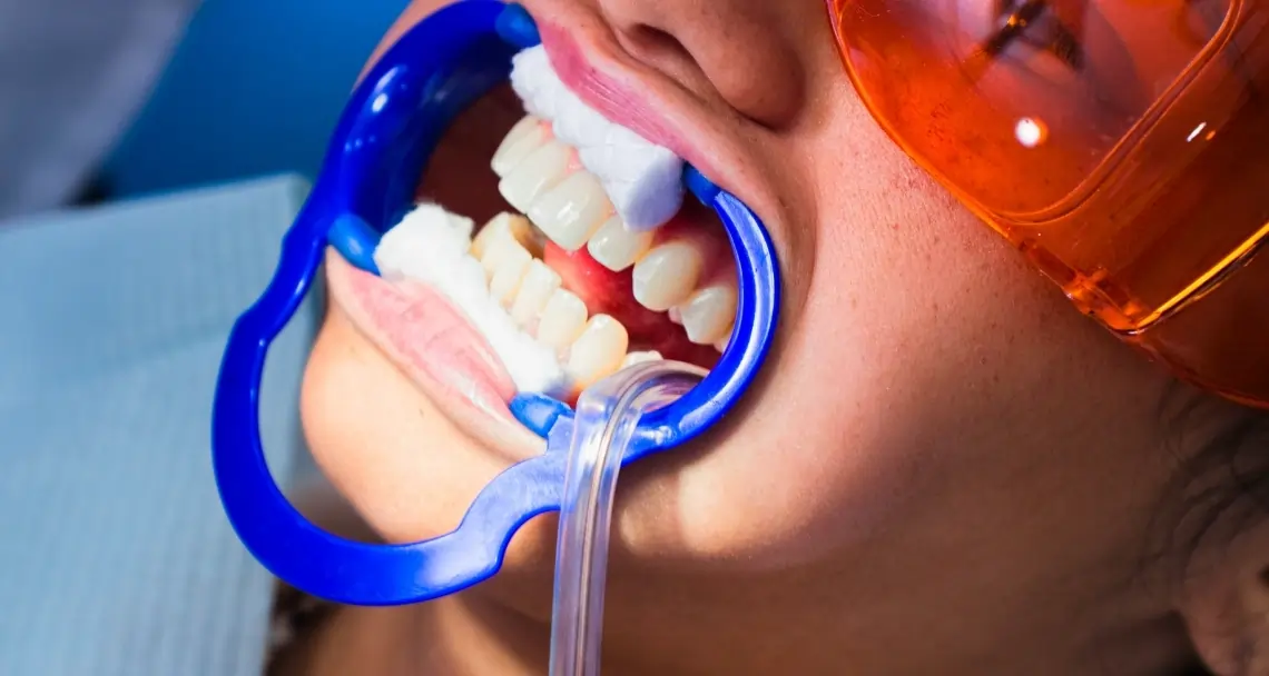 Is Laser Teeth Whitening Worth the Investment Rugby?