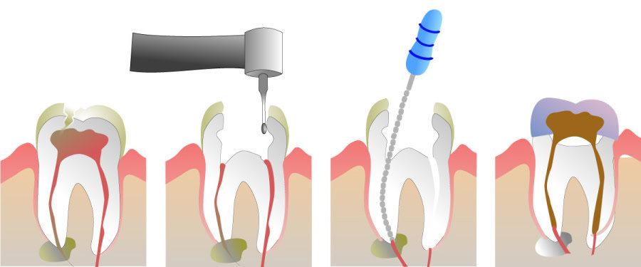 How Do You Properly Care for Your Teeth After a Root Canal Rugby