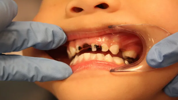 Tips for Keeping Your Child’s Baby Teeth Healthy and Strong Rugby