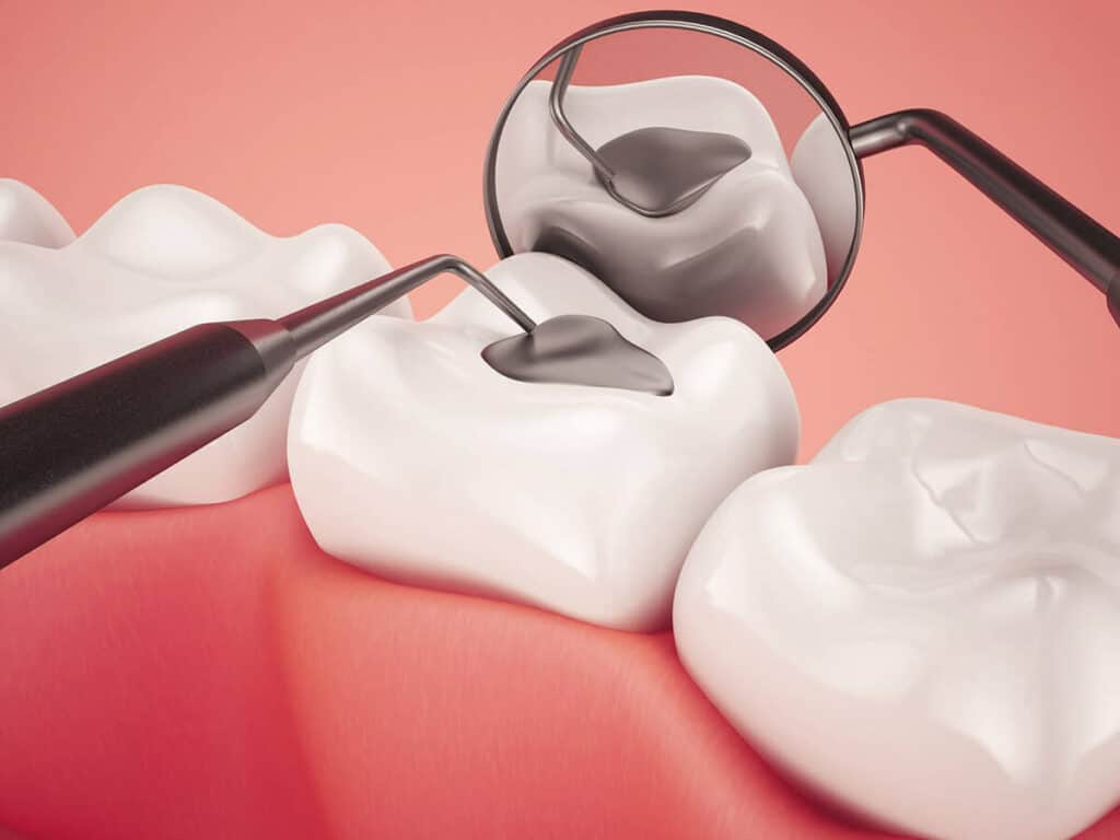Fighting Cavities and Plaque Buildup Rugby