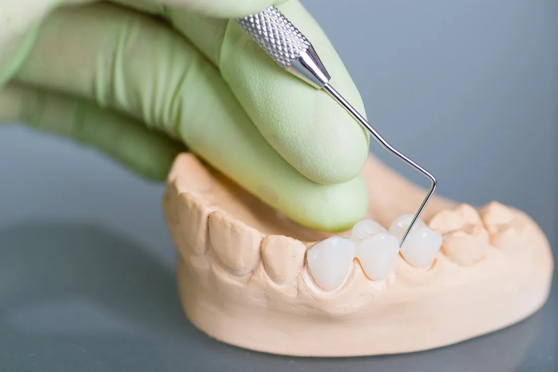 Do Braces Take Years to Show Results Rugby