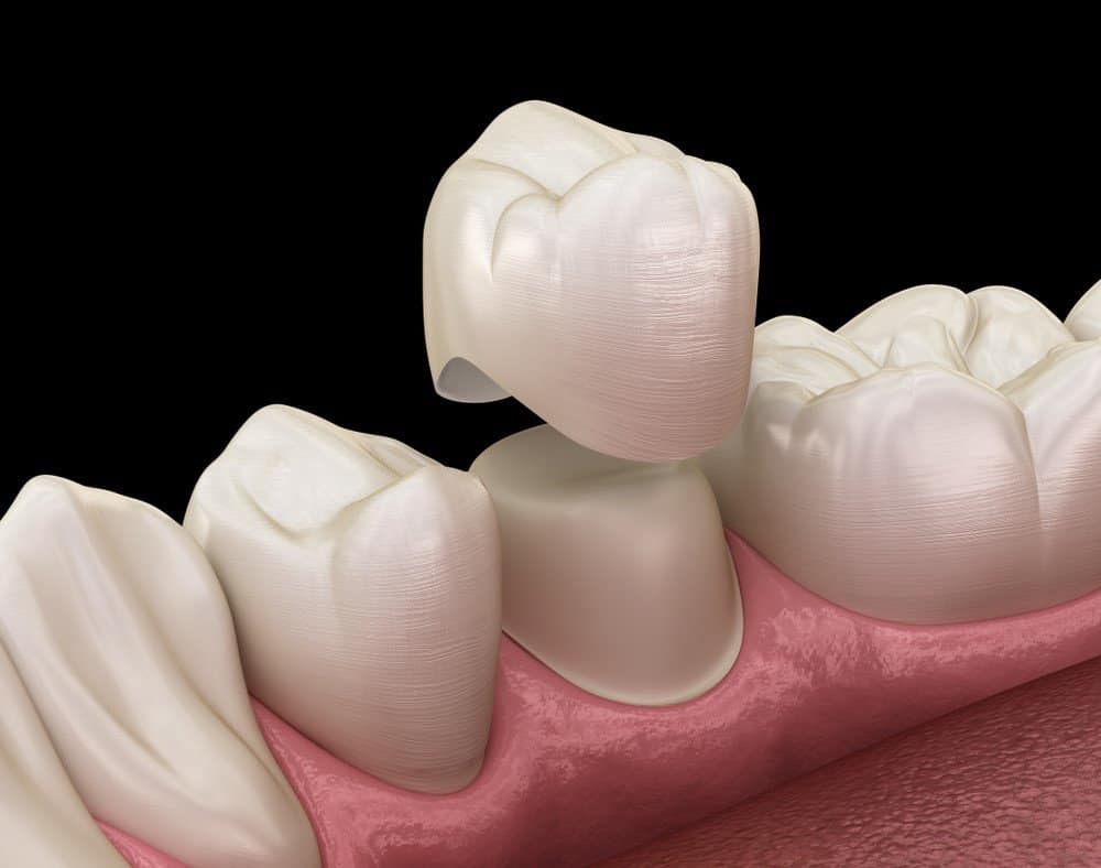 How Can You Prevent Common Dental Crown Problems Rugby?