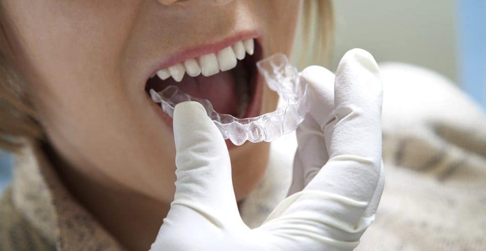 Why Bleaching Trays Require More Time Rugby