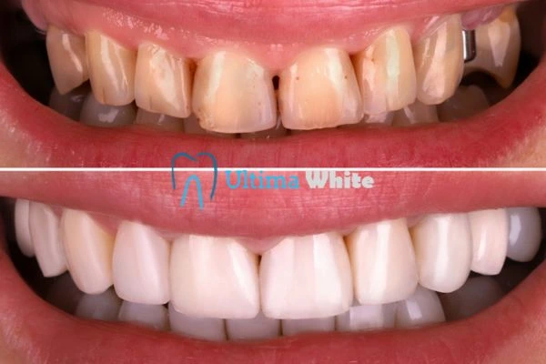 What Makes Instant Teeth Whitening Treatments So Popular Rugby?