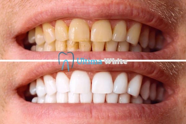 Stained Teeth and Persistent Bad Breath Rugby