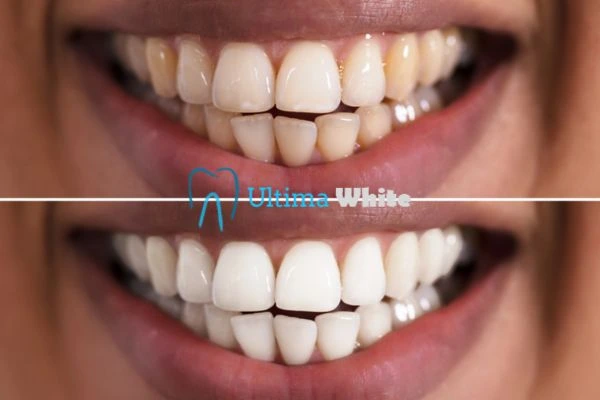 Aftercare Tips to Maintain Your New Smile Rugby